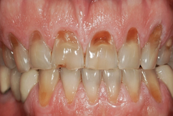 teeth grinding damage teeth grinding damage