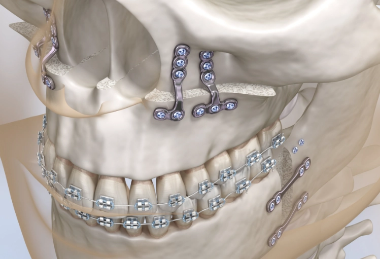 orthognathic surgery recovery