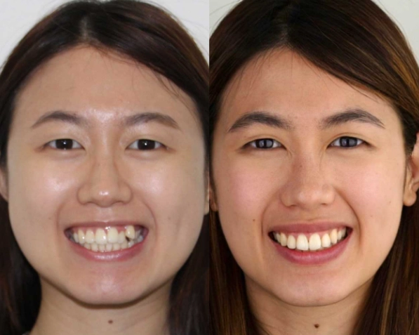 The Complete Guide to Orthodontics Before and After: What to Really Expect