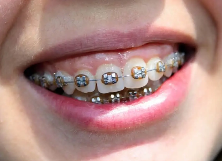 invisalign for overbite