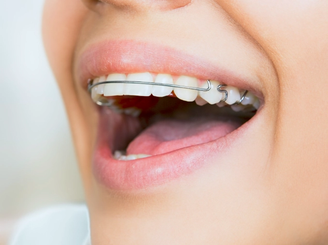 invisible aligners before and after invisible aligners before and after