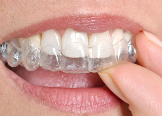 Fixing Underbite: Your Complete Guide to Diagnosis and Treatment