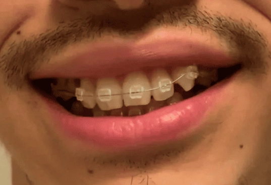 fix underbite