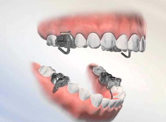 overbite correction cost