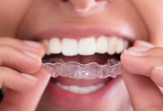 braces before and after braces before and after