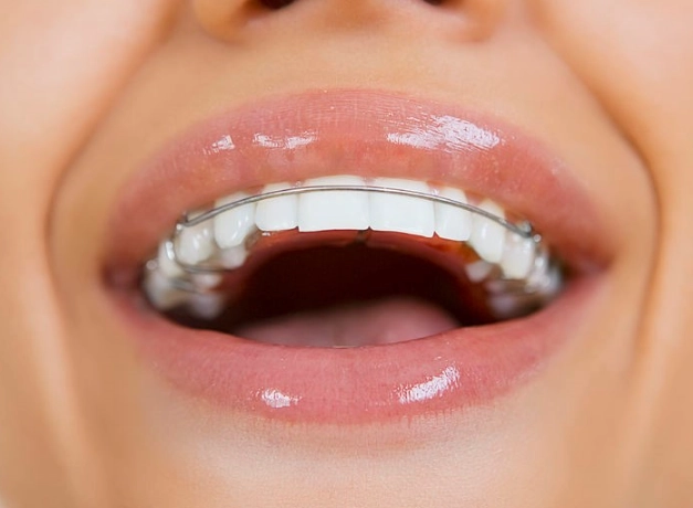 braces before and after braces before and after