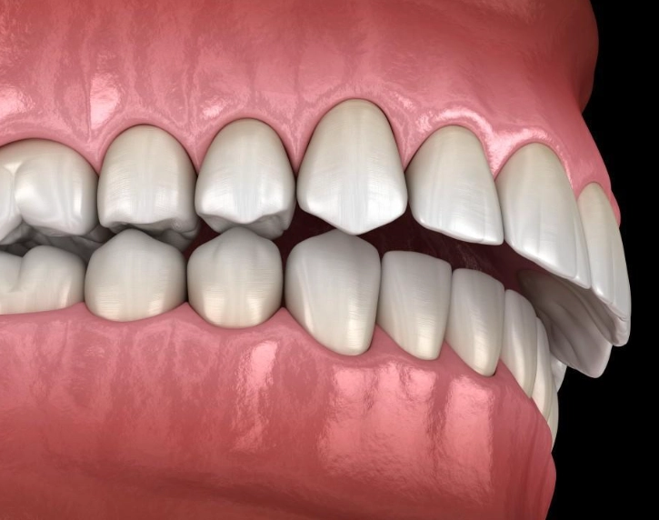 Correcting Overbite: Your Guide to Diagnosis, Treatment & Costs