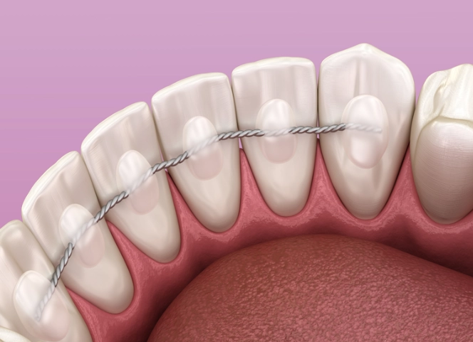 permanent retainer permanent retainer