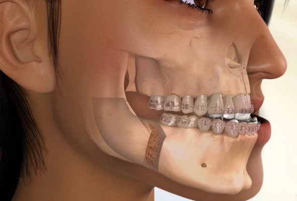orthognathic surgery recovery