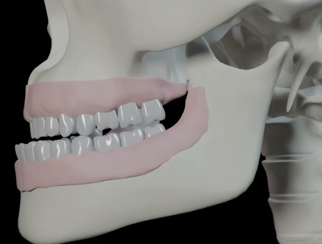 underbite correction