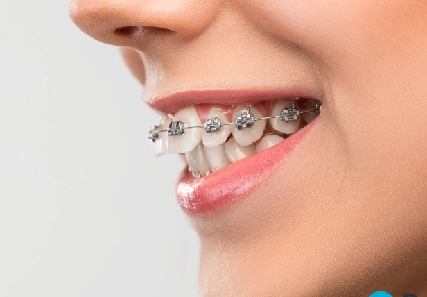 overbite correction cost