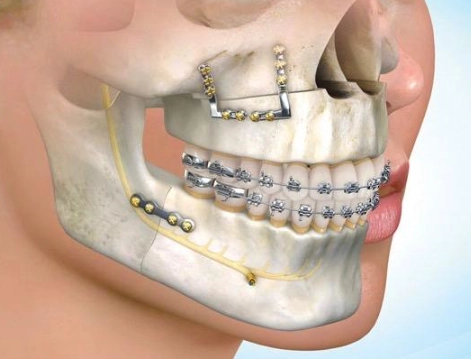 orthodontic surgery procedures
