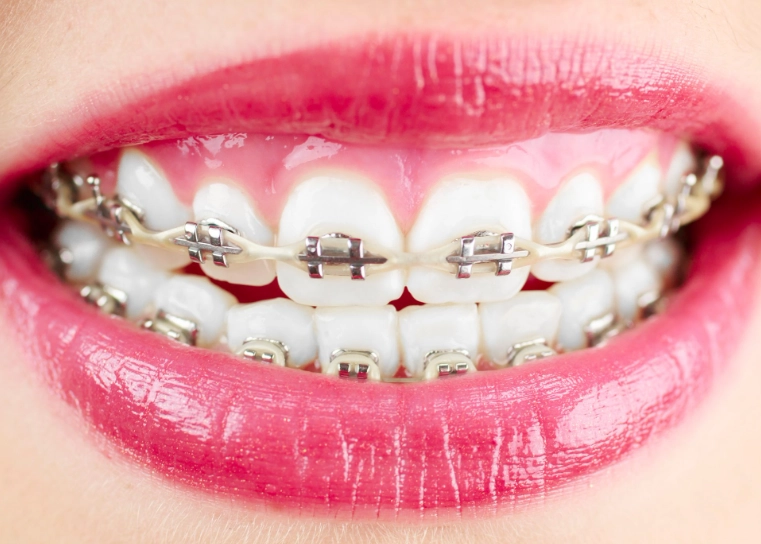metal braces vs invisalign