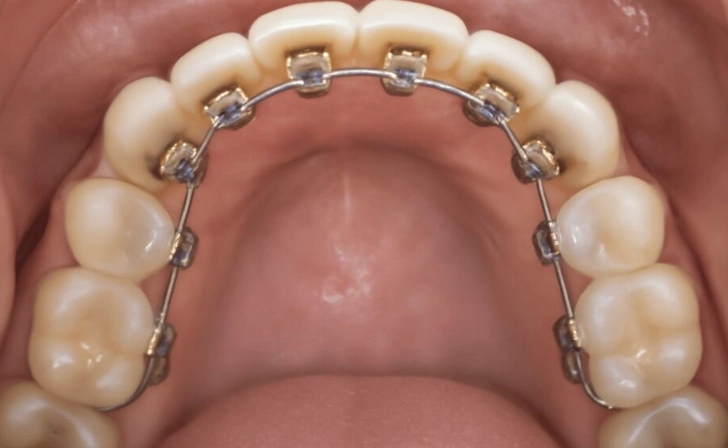 cost of lingual braces