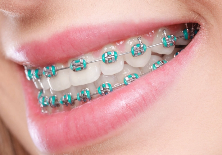cost of braces for adults