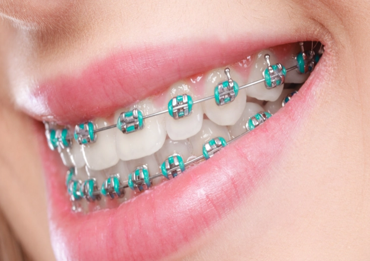 metal braces cost