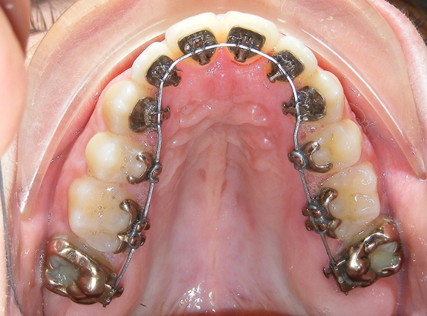 Lingual Braces: The Complete Guide to Invisible Teeth Straightening