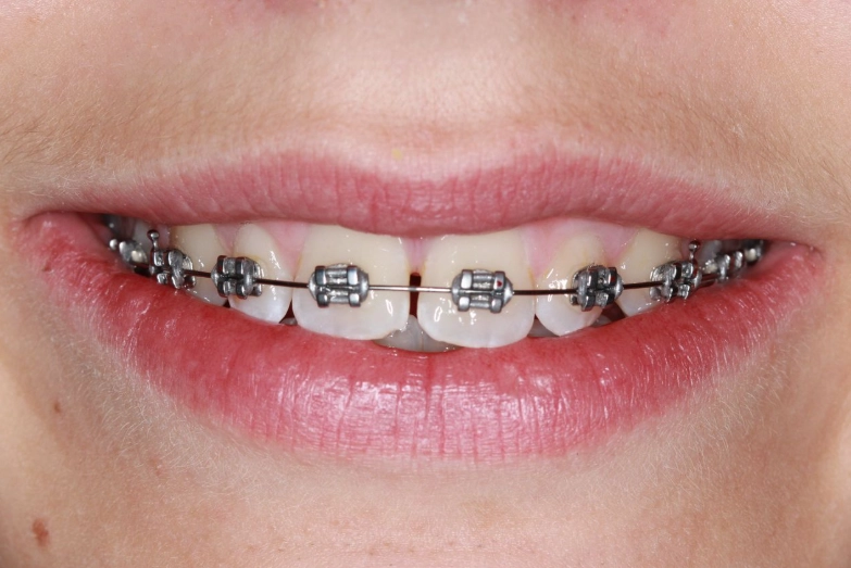 how to clean metal braces