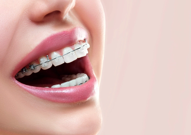 how to clean metal braces