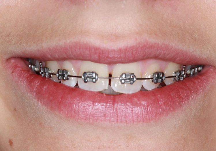 invisalign for adults