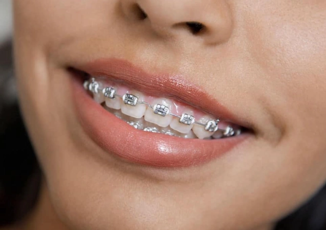 metal braces cost