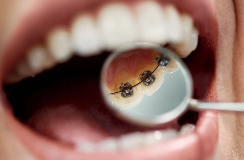 invisible braces for adults