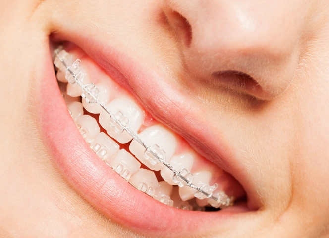 braces treatment steps