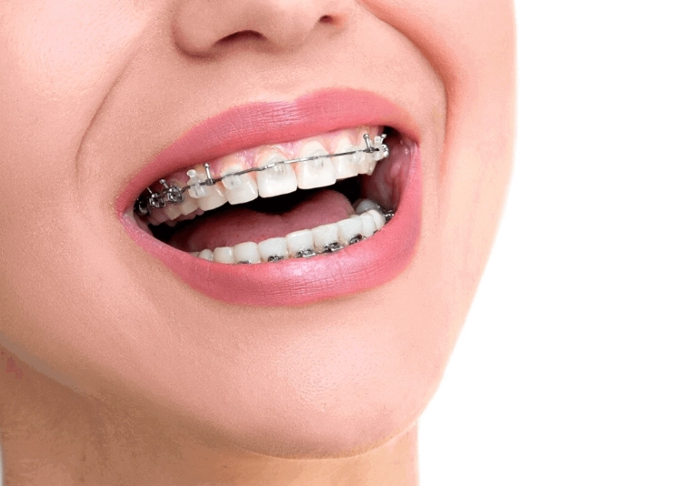 invisalign for adults