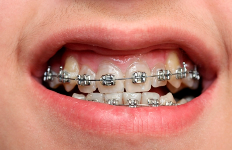 metal braces cost
