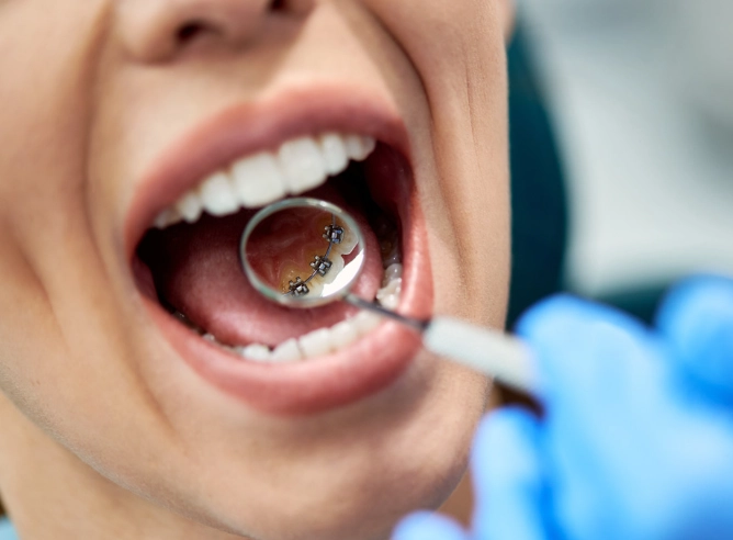 invisible braces for adults