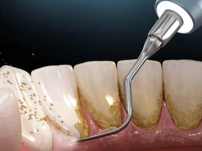 plaque removal at home plaque removal at home