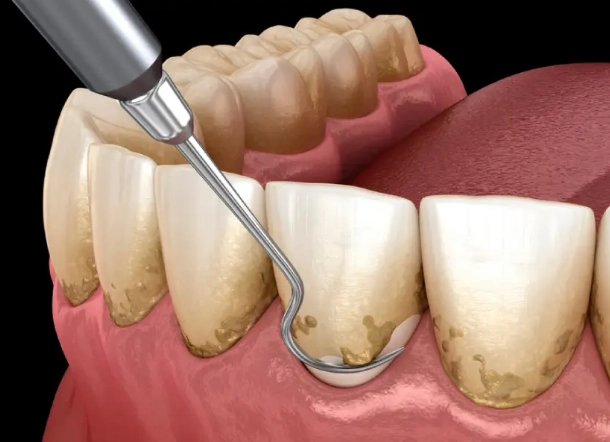 how to remove tartar from teeth