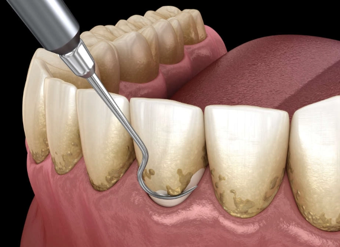 plaque removal at home plaque removal at home