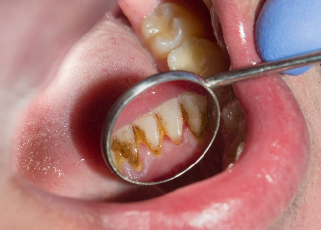 Tartar Control: The Complete Guide to Prevention and Removal