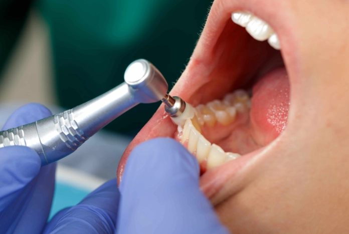 how to remove plaque how to remove plaque