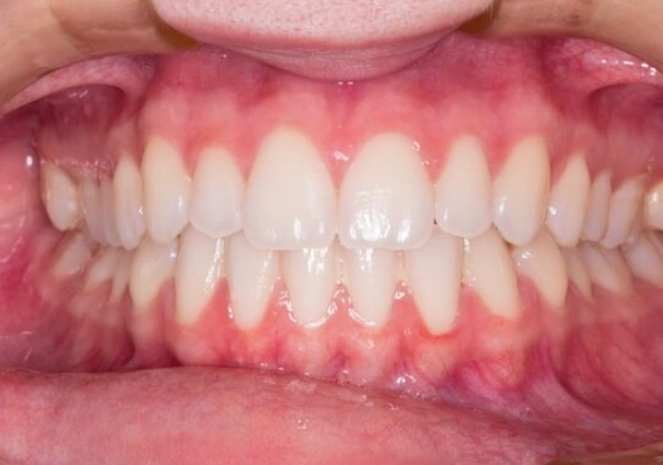 signs of gingivitis