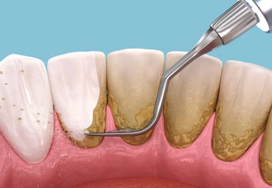 Plaque Removal Guide: Effective Methods for a Healthier Smile