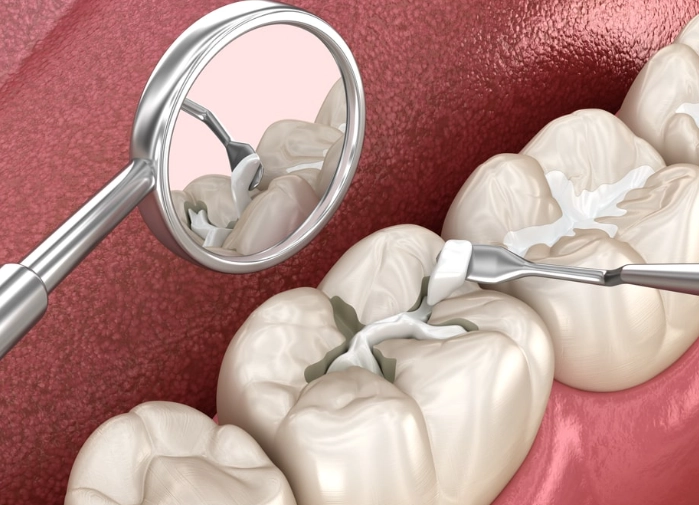 tooth hurts after filling