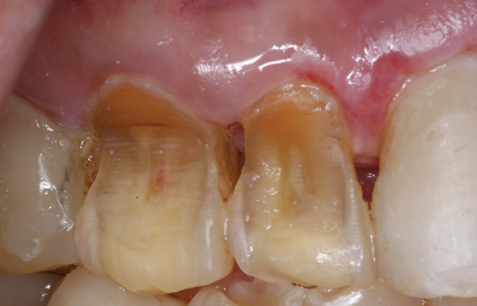 acid reflux teeth acid reflux teeth