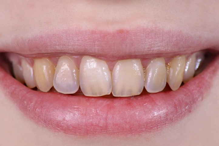 tooth sensitivity causes tooth sensitivity causes