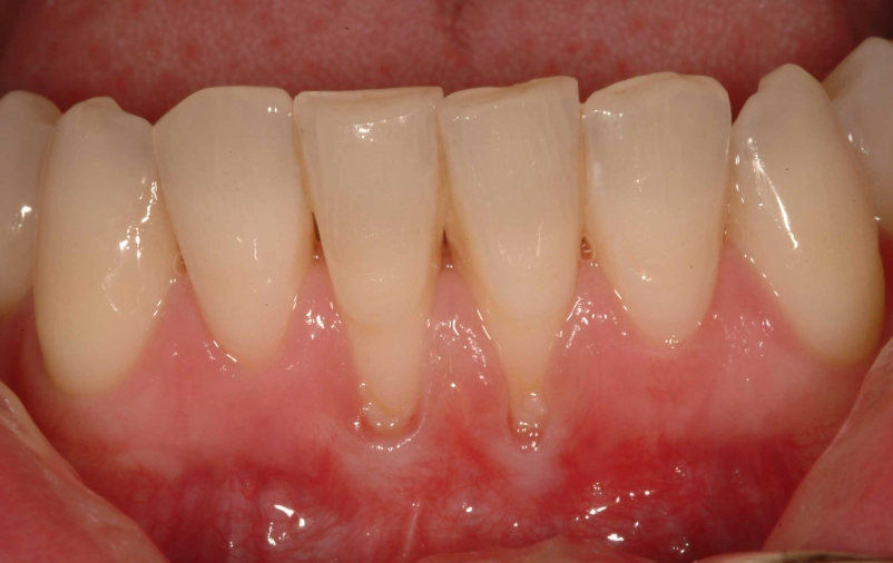 receding gums sensitive to cold