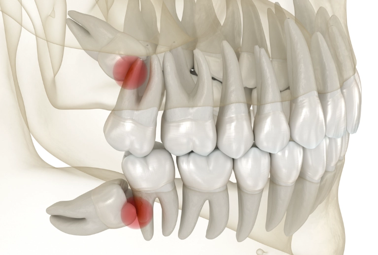 wisdom tooth pain relief wisdom tooth pain relief