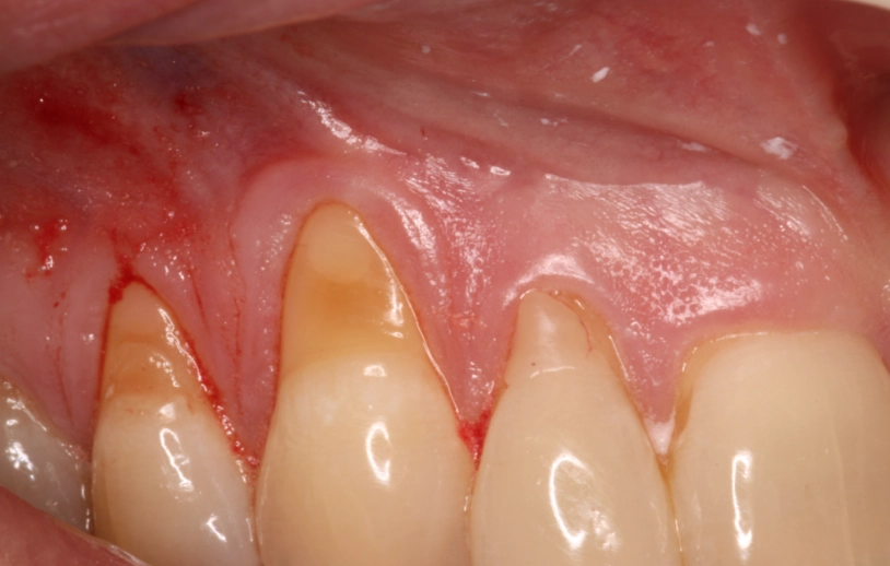 how to treat gum recession at home