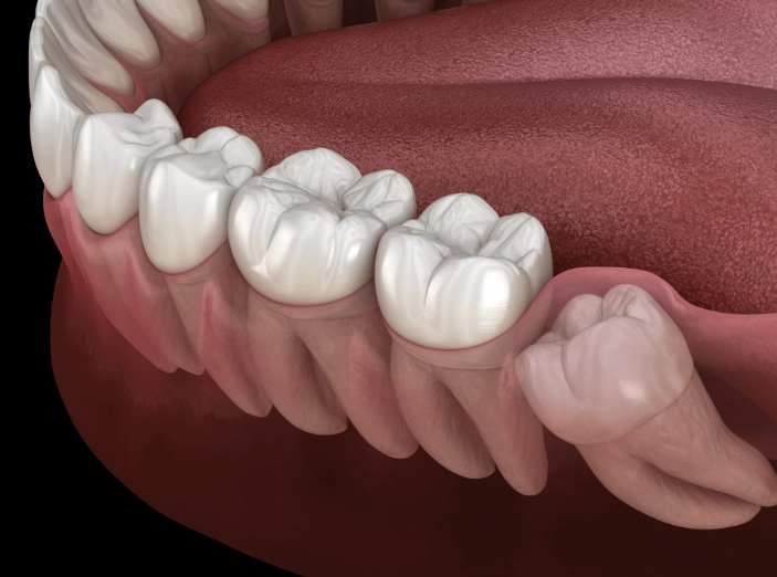 wisdom tooth removal wisdom tooth removal