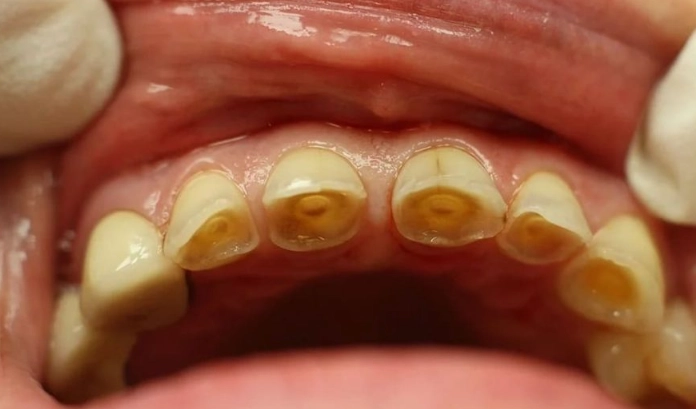 Enamel Erosion and Tooth Sensitivity: Causes, Prevention, and Solutions