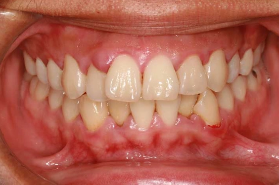 tooth sensitivity symptoms tooth sensitivity symptoms