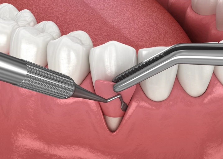 how to treat gum recession at home