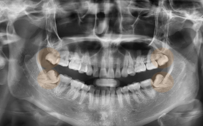 wisdom tooth removal wisdom tooth removal