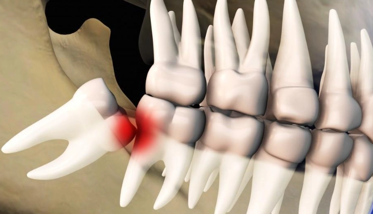 impacted wisdom tooth impacted wisdom tooth