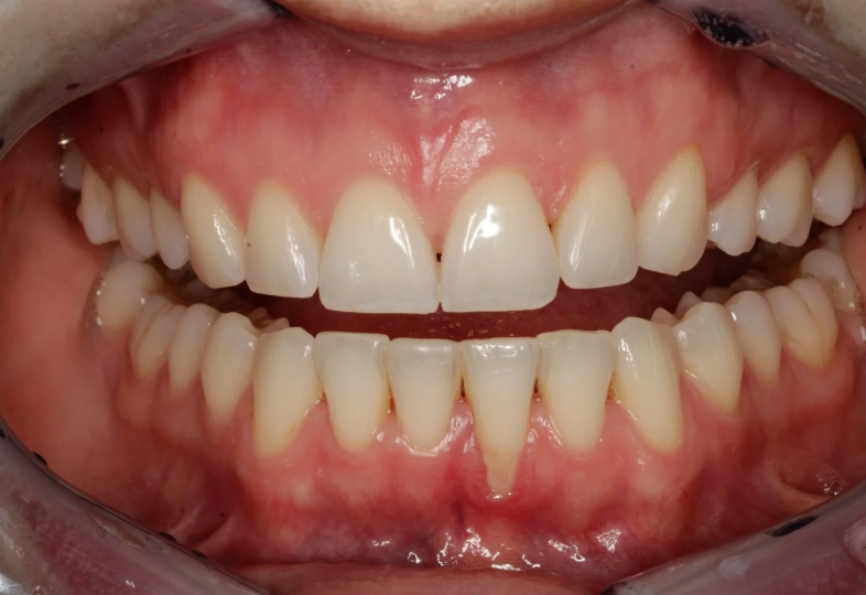 receding gums sensitive to cold